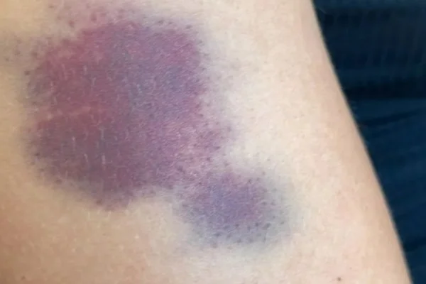 Mulher ficou com hematoma em braço após ser agredida por companheiro em Paraúna, Goiás