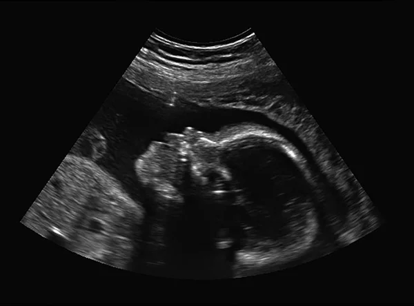 Mãe desabafa sobre luta por aborto: “Meu bebê se mutilava no útero”