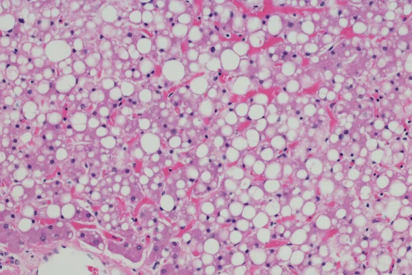 Imagem de microscópio mostra tecido do fígado com gordura, condição chamada de esteatose hepática - Metrópoles - obesidade