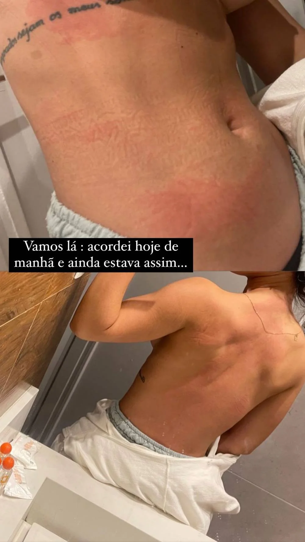 Ela não sabe o que aconteceu, mas acredita que a vermelhidão foi causada por algo que ela comeu Ela não sabe o que aconteceu, mas acredita que a vermelhidão foi causada por algo que ela comeu