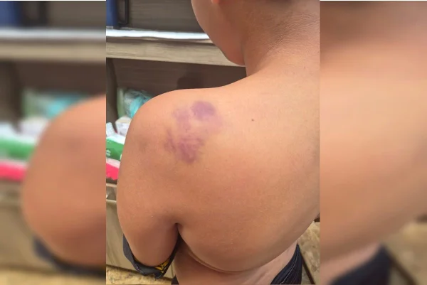 hematoma em criança