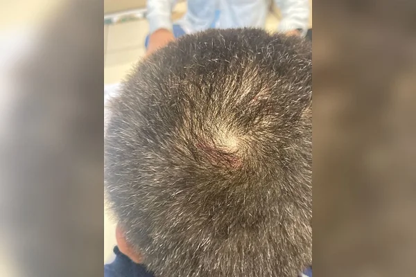 Criança queimada com frigideira foge de casa e pede ajuda a policiais- RJ 2