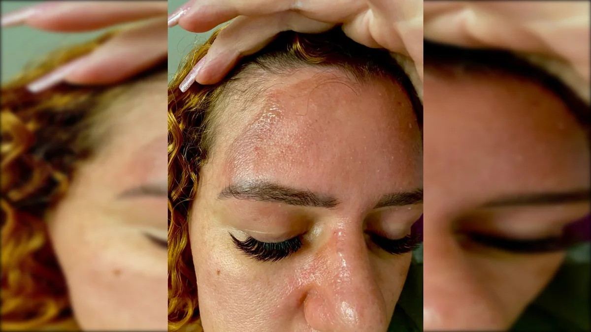 Rosto com marcas de queimaduras - Metrópoles