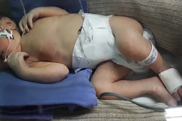 Bebê de 1 mês aguarda cirurgia emergencial, mas Saúde ignora liminar