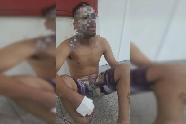 Mulher queima rosto do companheiro com água fervendo após agressão