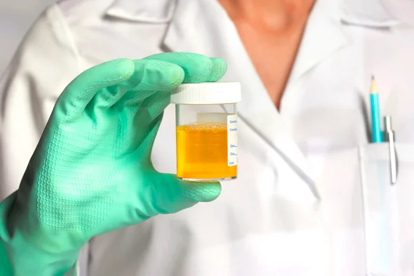 Médico/a segurando uma amostra de urina dentro de um frasco transparente - Metrópoles