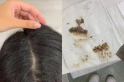 Mulher ganha cerca de R$ 800 por hora para catar piolhos e lêndeas