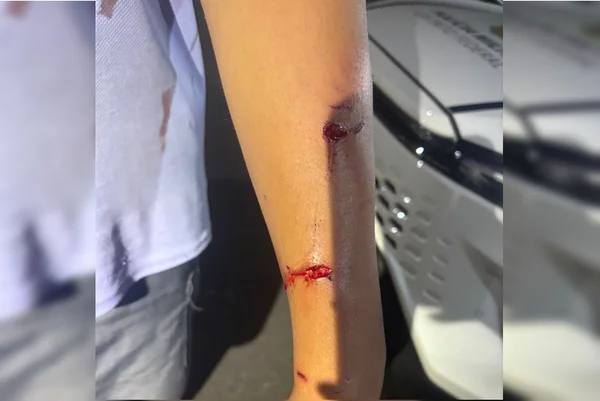 Veja como ficaram criança e policial atacados por pit-bulls no DF