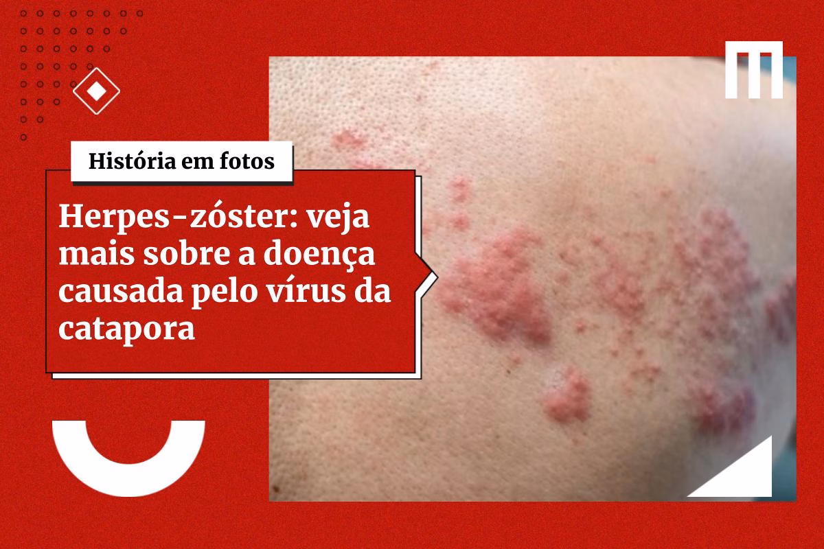 3-Cards_Galeria_de_Fotos-6-24 Vacina contra herpes-zóster reduz risco de AVC e infarto, diz estudo