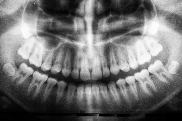 Bombeiro usa prego para tirar pipoca de dente e quase morre