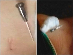 Paciente acha agulha ‘esquecida’ no bumbum após injeção