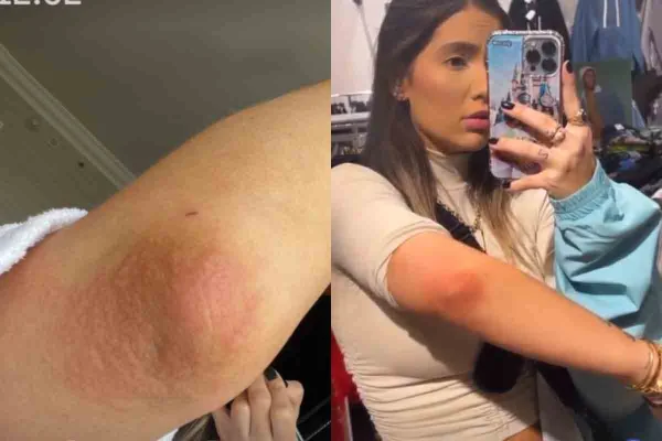 Fotos colorida de Virginia Fonseca com alergia