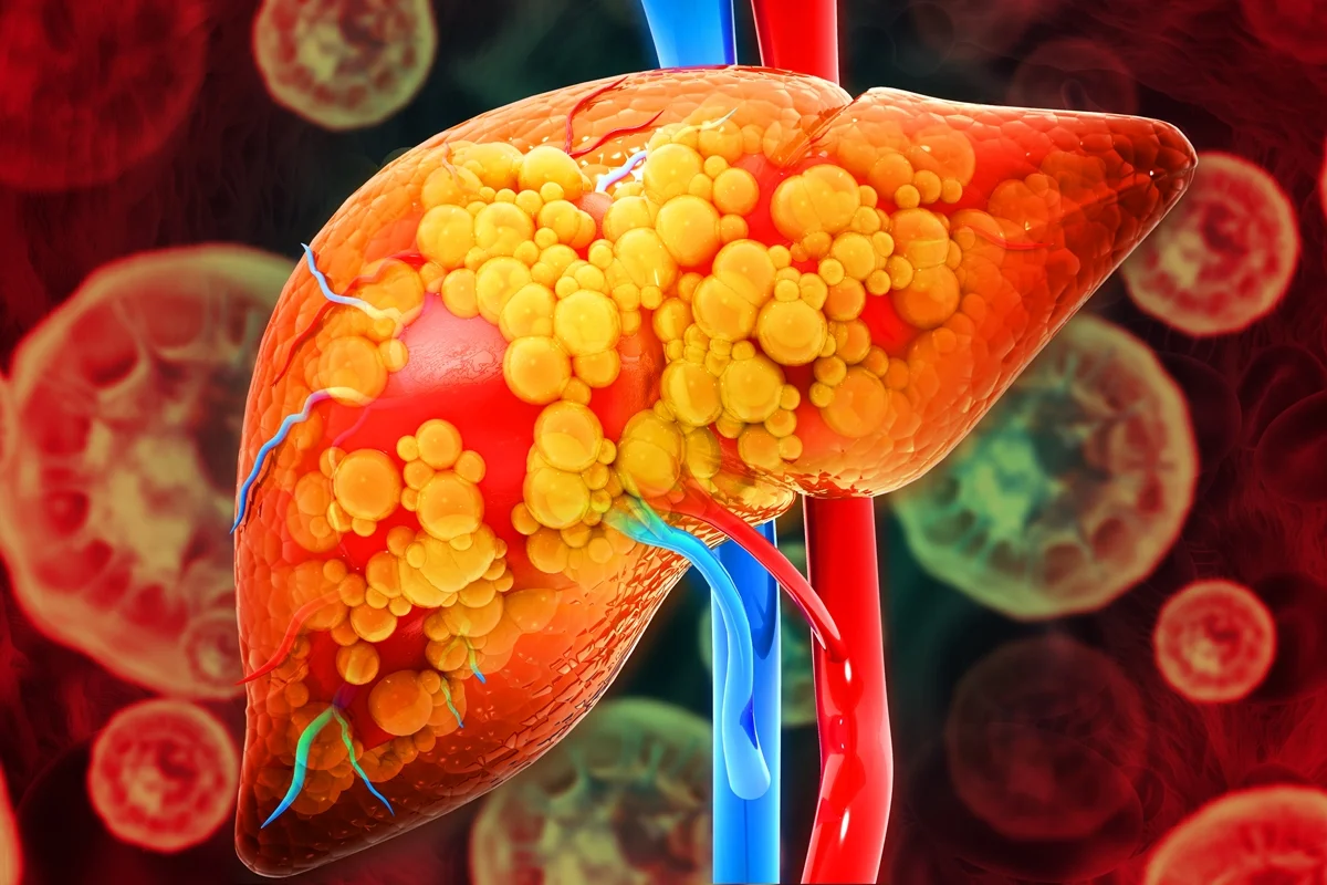 nutri indica 10 alimentos que ajudam a prevenir o quadro — Gordura no fígado