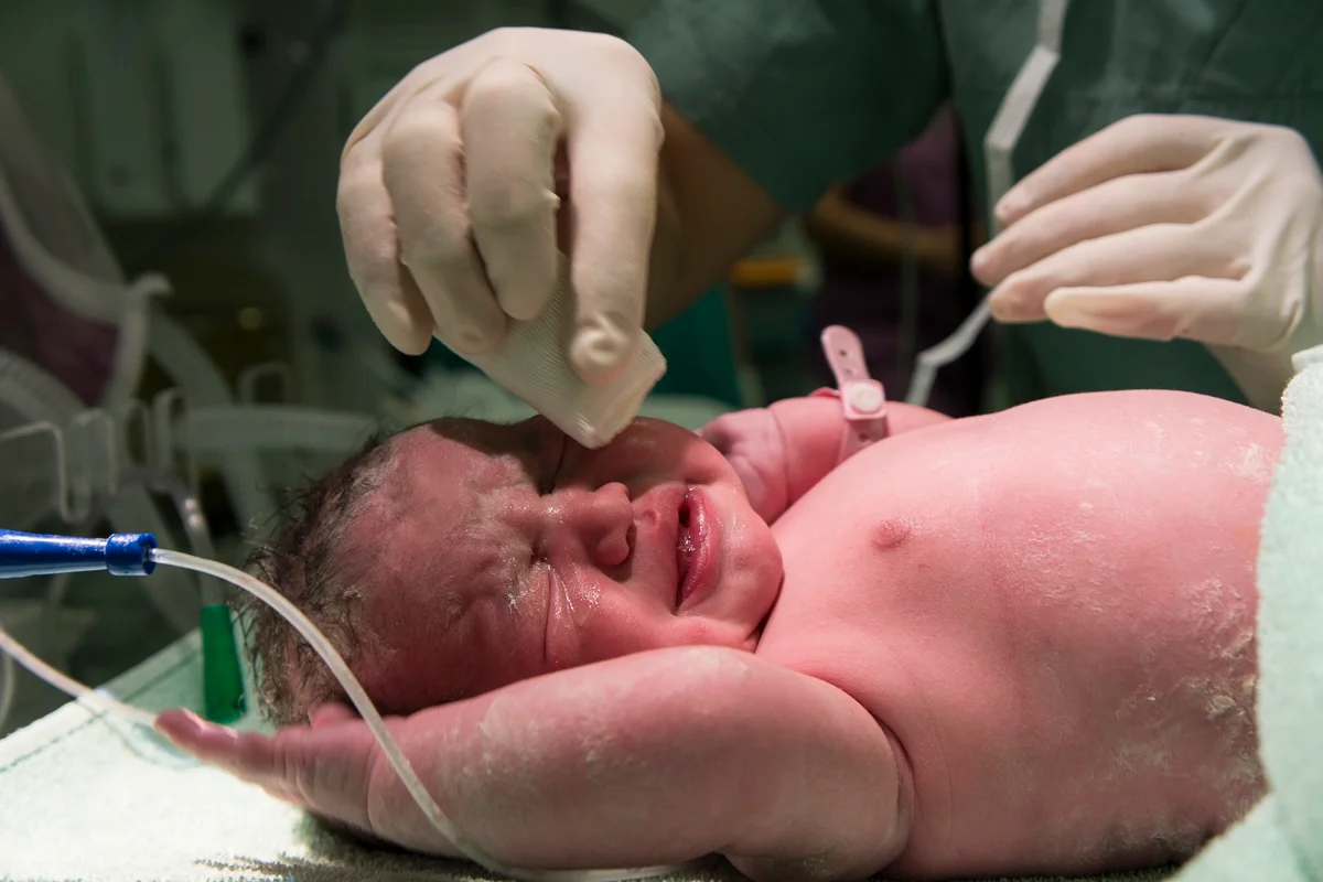 Brasil lidera ranking global de cesáreas: 55% dos nascimentos são cirúrgicos e o custo para o SUS cresce