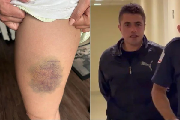 Imagem colorida mostra ferimentos em nutricionista e homem preso por estupro. Metrópoles