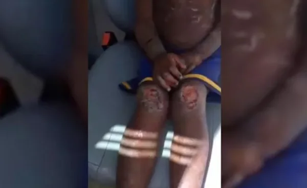 Uma das crianças teve vários ferimentos pelo corpo, assim como os irmãos, segundo a polícia