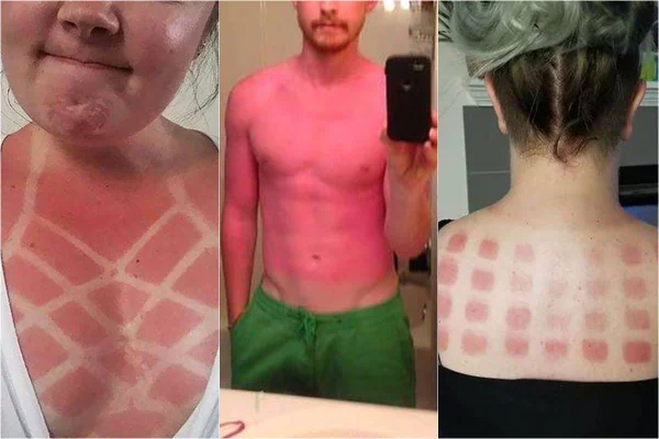 Queimaduras por onda de calor