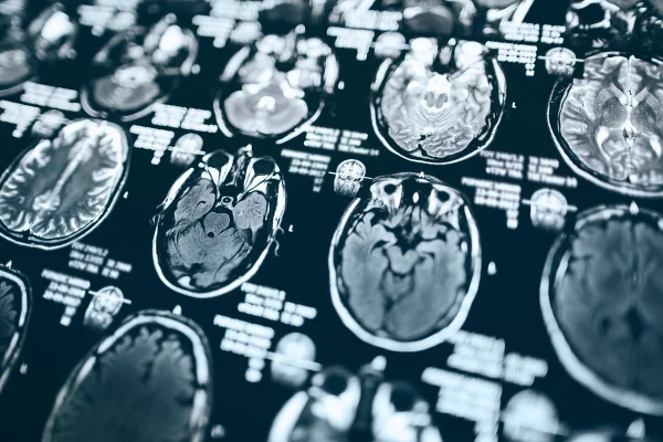 Ressonância magnética da cabeça, imagem por ressonância magnética da cabeça - Dieta mediterrânea pode reduzir risco de Alzheimer, diz estudo - - AVC
