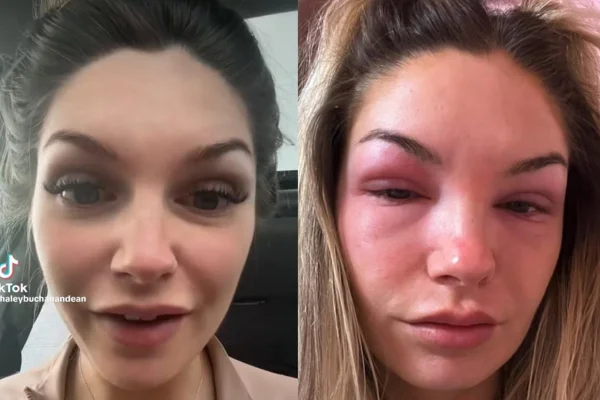 Imagem da cabeleireira Haley Dean que desenvolveu alergia após colocar cílios postiços