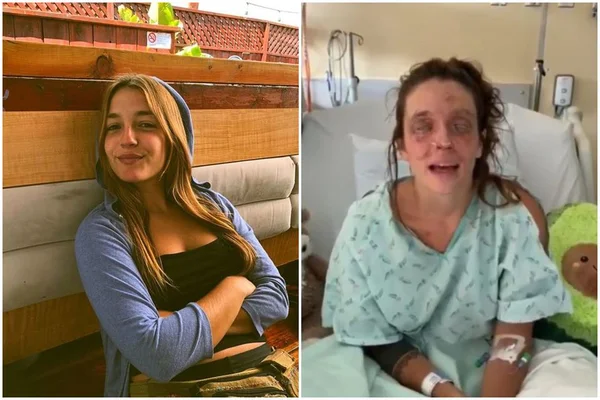 Mulher fica cega após maquiagem caseira causar queimaduras nos olhos dela