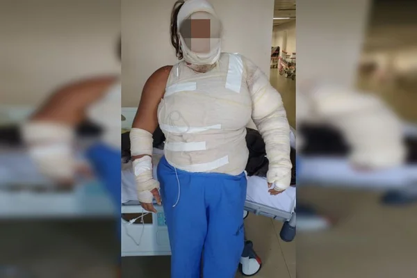 “Vou te queimar”, diz homem antes de cumprir ameaça e atear fogo em mulher