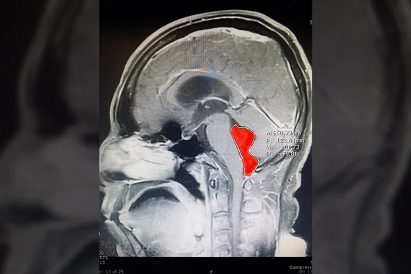 Após crises de dor de cabeça, homem descobre tênia no cérebro