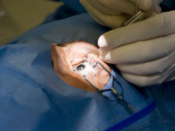 Foto colorida de pessoa fazendo cirurgia no olho. Imagem ilustrativa - Metrópoles