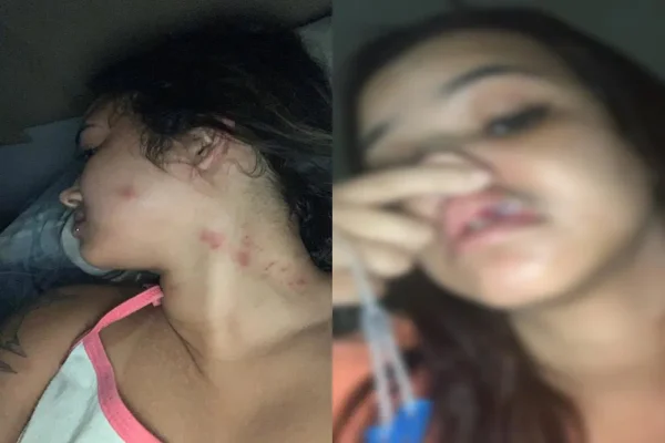 Imagem colorida, Beatriz Ramos com sinais de possíveis agressões no rosto- Metrópoles