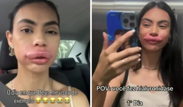 Modelo de SC fica irreconhecível ao remover preenchimento labial - Metrópoles