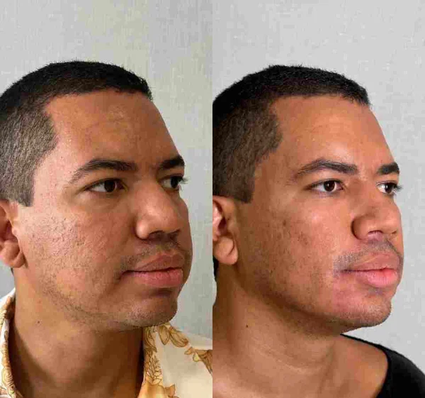 Ex-BBB23 Bruno Gaga realiza harmonização facial. Saiba o valor!