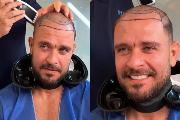 Caso Diogo Nogueira: quando é preciso refazer o transplante capilar?