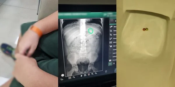 Imagens coloridas de criança no hospital, uma imagem do raio-x e outra das bolinhas em um vaso sanitário - Metrópoles