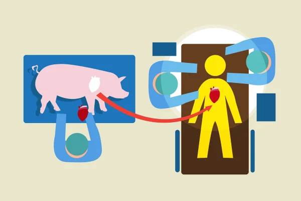 Ilustração de transplante de porco - Metrópoles