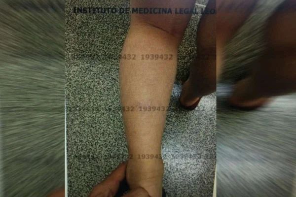 hematomas