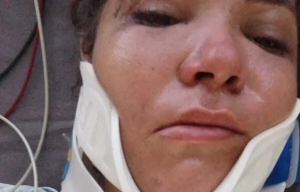 Em foto colorida mulher com colar cervical em plano fechado de foto -Metrópoles