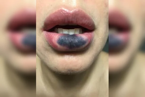 “Desesperada”: pacientes dizem que tiveram face deformada por dentista