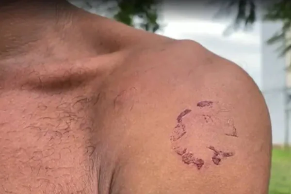 Trabalhador resgatado em vinícola mostra cicatriz - Metrópoles