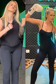 Ela publicou o antes e depois do início do tratamento de lipedema Ela publicou o antes e depois do início do tratamento de lipedema