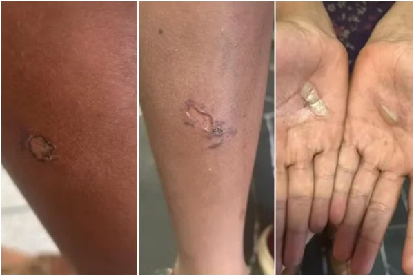 Meninas são torturadas e queimadas por pai por som quebrado