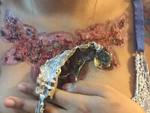 Garota relata momentos de dor ao remover tatuagem com método polêmico - imagem 7 Garota relata momentos de dor ao remover tatuagem com método polêmico - imagem 7