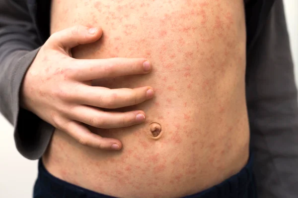 Criança com manchas vermelhas na barriga causadas pelo sarampo - Metrópoles