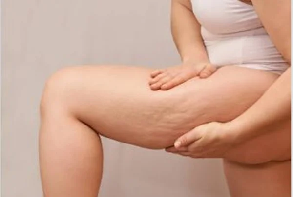 mulher apertando a coxa para mostrar as celulites - Metrópoles