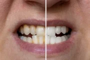 A higiene bucal previne doenças A higiene bucal previne doenças