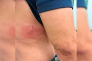 Lesão nas costas