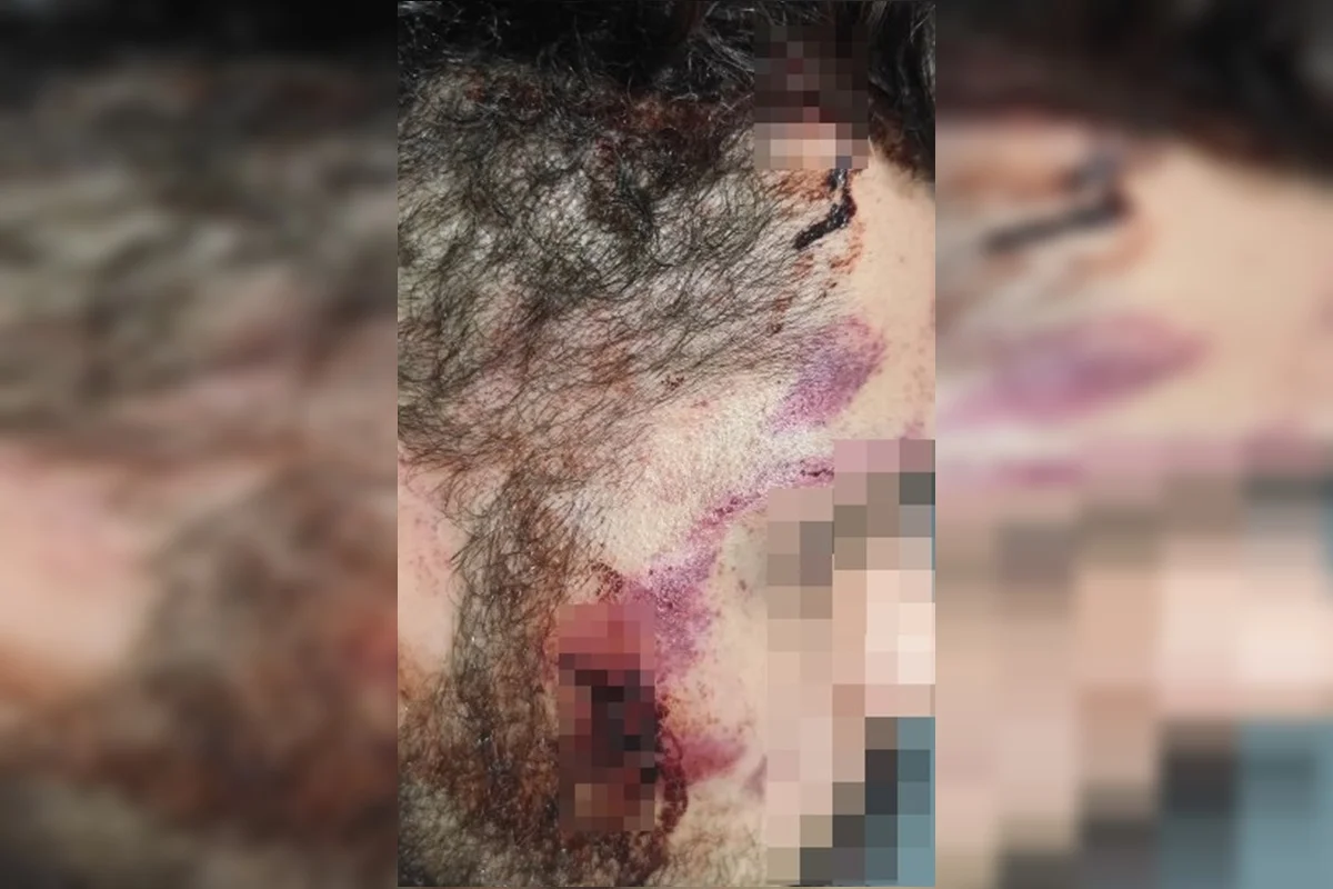 Hematomas no rosto Hematomas no rosto