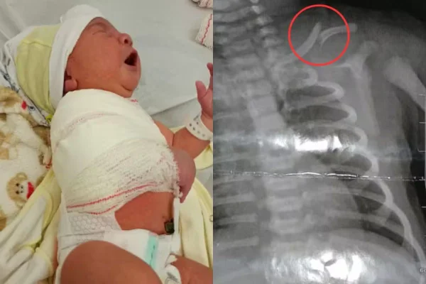 Montagem com um bebê à esquerda e um raio-x à direita