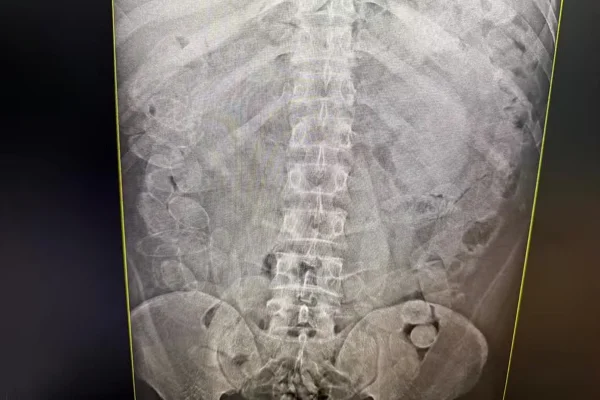 Bolivianos são presos ao tentar entrar no Brasil com drogas na cueca