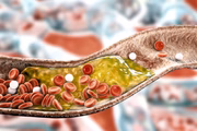 Dentre as doenças cardiovasculares que mais fazem vítimas fatais, o Acidente Vascular Cerebral (AVC) se destaca. Ele é causado devido à presença de placas de gordura que entopem os vasos sanguíneos cerebrais. Entre os sintomas estão: dificuldade para falar, tontura, dificuldade para engolir, fraqueza de um lado do corpo, entre outros Dentre as doenças cardiovasculares que mais fazem vítimas fatais, o Acidente Vascular Cerebral (AVC) se destaca. Ele é causado devido à presença de placas de gordura que entopem os vasos sanguíneos cerebrais. Entre os sintomas estão: dificuldade para falar, tontura, dificuldade para engolir, fraqueza de um lado do corpo, entre outros