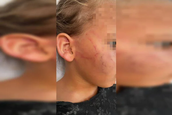 Mulher é presa após morder rosto e orelha de filha de 4 anos