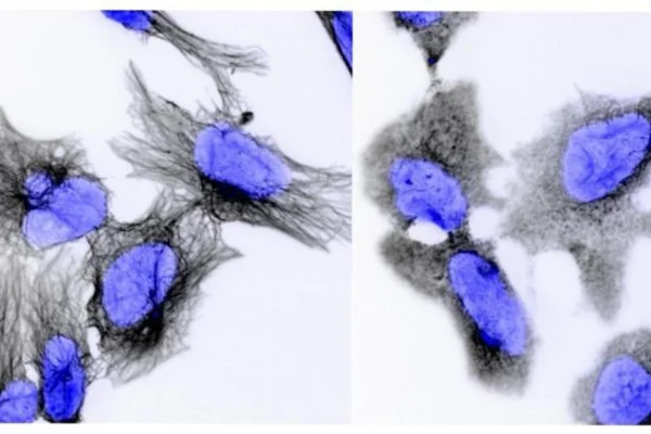 Células de neuroblastoma antes (esquerda) e depois (direita) da quimioterapia. Os filamentos pretos são a estrutura interna da célula, que se rompe durante o tratamento. Metrópoles